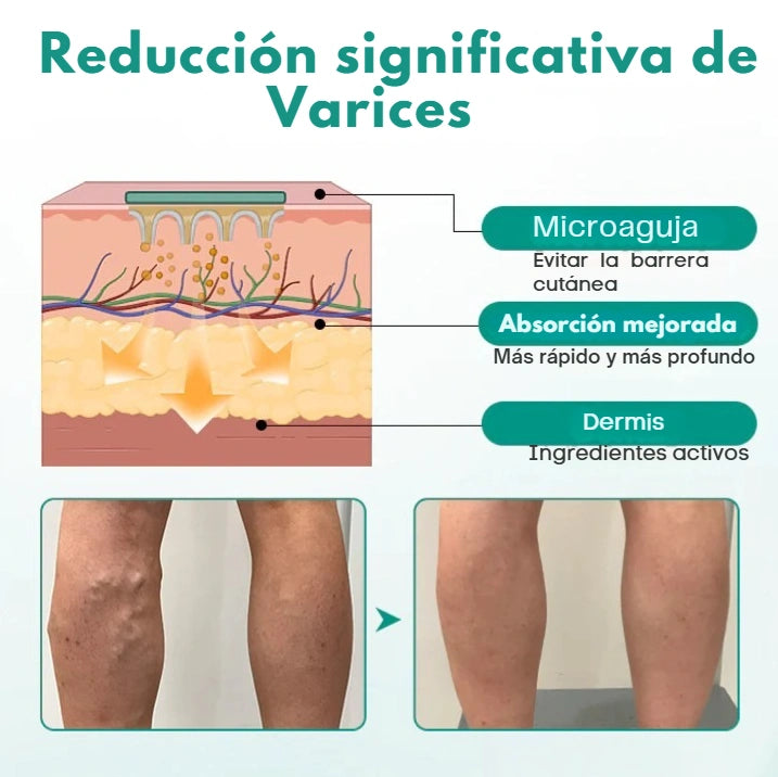 Parche para venas varicosas Timilk®
